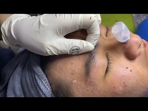 Removing Large Mature Pores & Long Cystic Pimples | Deep Facial Extraction at Spa Linh Mun #13
