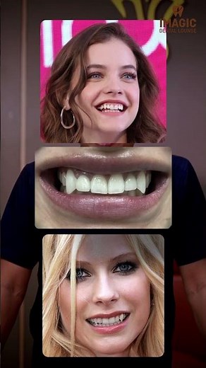 നിങ്ങൾക്കും Normal Teeth Vampire Teeth ആക്കണോ? #vampireteeth #vampire #canineteeth #smilemakeover