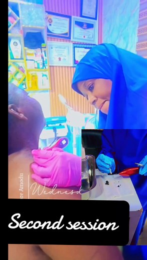 #CapCut #keloid, #skintagremoval #syringoma