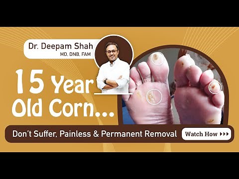 Laser Corn Removal | Foot Corn Treatment by Laser | Dr. Deepam Shah