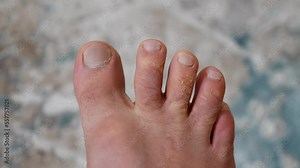 calluses and fungus on the toes, foot fungal diseases, itchy foot diseases, Stock Video