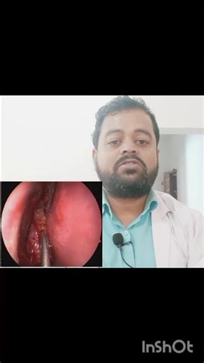 Endoscopic DCR Surgery Procedure