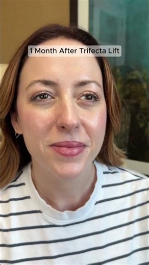 🥳 TRIFECTA LIFT WINNER: 1 Month Post-Op!