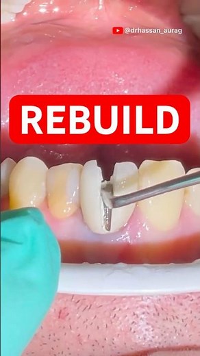 Failing Crown → Post Removal, Core Build-Up & New Crown in One Visit