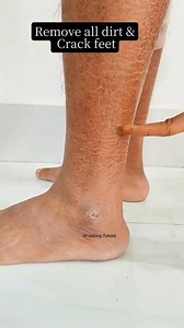 857K views · 2.8K reactions | Remove Feets Instantly | Feet Care Tips | Winter Skin CareTips ✅ . . . #softfeet #smoothfeet #ridofcrackedheels #fairfeettips #tanremoval #reelsvideoシ #reelsviralシ #fbreelsfypシ゚ #fblifestyle #reelschallenge | Natural Beauty Tips | Facebook