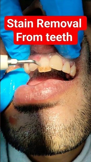 Stain Removal From Teeth By Machine l Stain Removal l Scaling l Oral Prophylaxis