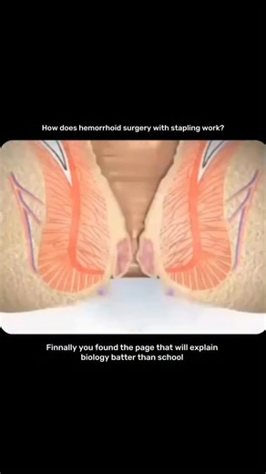 MEDICAL / BIO / SCIENCE on Instagram: "🩺📎 A cirurgia de hemorróida com grampeamento é uma técnica moderna usada para tratar hemorroidas internas de forma menos dolorosa que os métodos tradicionais. Em vez de remover o tecido hemorroidário, o procedimento reposiciona a mucosa que deslizou e interrompe o fluxo sanguíneo que alimenta as hemorroidas.Durante a cirurgia, um dispositivo especial insere um anel de grampos que corta e grampeia a mucosa ao mesmo tempo ✂️➡️📎. Isso reduz o excesso de tec