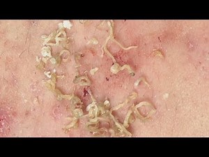 CRAZY ACNES & BLACKHEADS REMOVAL | Lấy mụn ẩn dưới da, mụn đầu đen | 黑頭和粉刺去除 | 0934000075