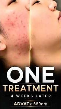 ADVATx Acne Redness Results | 4 Weeks After One Treatment