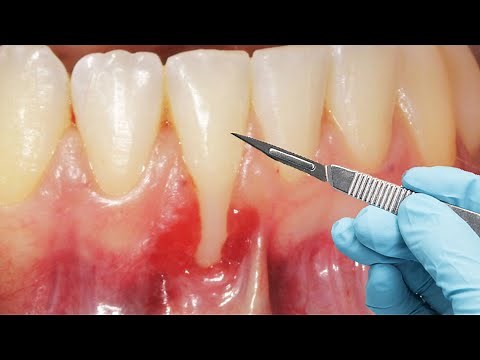 This Woman Had 3 Painful Gum Grafts... IT DIDN'T WORK