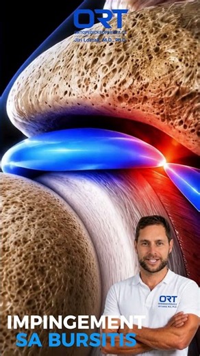 Shoulder Pain When Lifting the Arm? 🔥 Subacromial Impingement & Bursitis