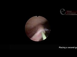Tips & Tricks in Ureteroscopy - An Easy way to place a second guidewire