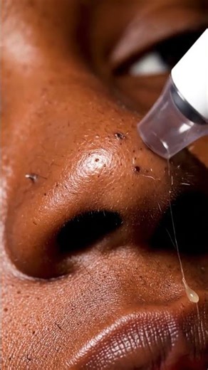 Satisfying Sebum Filaments Removal 😌✨ #PoreCleaning #SkincareASMR