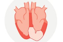 Hypertrophic cardiomyopathy (HCM)
