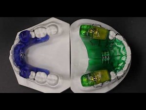 Class 2 II Correction, Twin Block https://www.straightsmilesolutions.com/