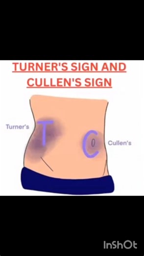 pancreatitis -Turnur's sign, culleng's sign