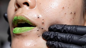 #acnetreatment #satisfying #ถอนขน #acne #pimple #blackheads #lashes #skincare #สิว | I'm Ai89