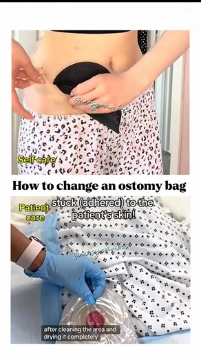 172K views · 942 reactions | *How to change an ostomy bag #fblifestyle #nurses #nurselife #caregiverlife #ostomycare #narsyamvibes #everyonefollowers #followersreels #foryoupagereels #fypシ゚ | Iamnurse Vibes | Facebook