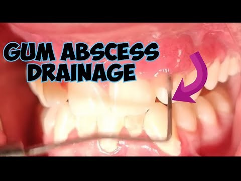 GUM ABSCESS drainage -FULL VIDEO
