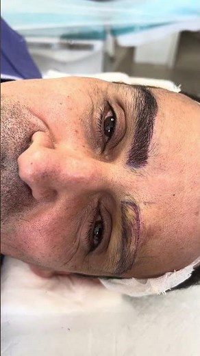 Men’s Eyebrow Transplant: Cost, Procedure, Results & Natural-Looking Eyebrow Restoration