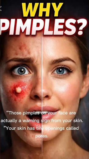 Why You Get Pimples (Your Skin Is Warning You)#Pimples#SkinCare#HumanBody#Anatomy