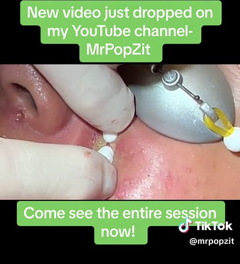 Check out his series of 6 videos on his way to clear skin on YouTube at MrPopZit. #medicaleducation #dermatology #skincare #mrpopzit #mrpopzitlive #youtube #youtuber #physicianassociate #skin #popaholic #extractions #acne #acneskin #acnetreatment #ingrownhair