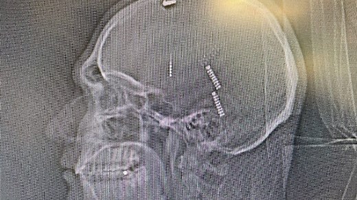 Could pulsing the brain with electrical signals help curb opioid cravings?