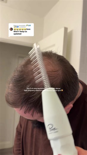 Transform Your Skin: Day 5 with the High Frequency Wand