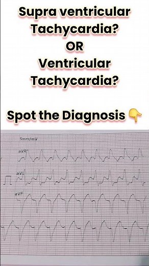 SVT or VT? Spot the diagnosis through the given ECG | Doctor Speaks #ecg #cardiology #arrhythmia