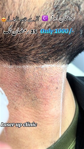 Ramadan Offers at Laser Up Clinic in Peshawar