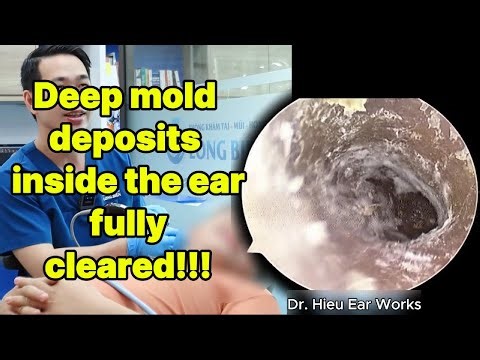 Deep mold deposits inside the ear fully cleared | ear cleaning | ASMR earwax | soothing |relax|