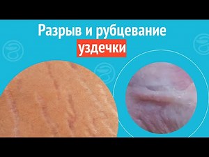 🥴 Frenulum rupture and scarring. Case report #1365