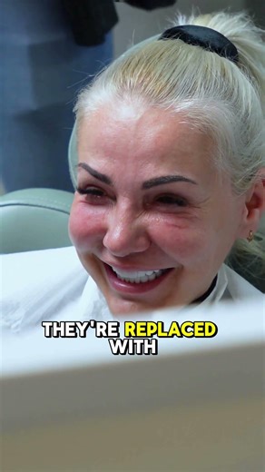 Why Remove Old Silver Fillings?🦷 Safe Removal & Smile Transformation