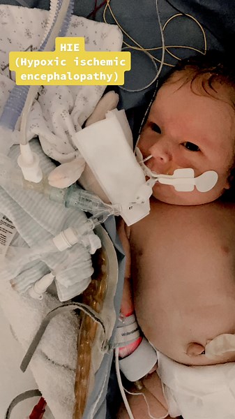 Cobie received cooling treatment an hour and a half after he was born, this slowed down the damage to his brain and gave his body chance to recover. It was a very scary time as we weren’t sure he was going to pull through. I truly believe this treatment saved his life🤍 #hypoxicischemicencephalopothy #hie #hopeforhie #nicu #hypothermia #cooling #braindamagesurvivor #brave #ngtube #postpartum #seizure