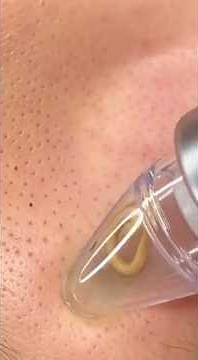 Satisfying Blackhead Removal: Does This Pore Vacuum Really Work? (Before & After!)