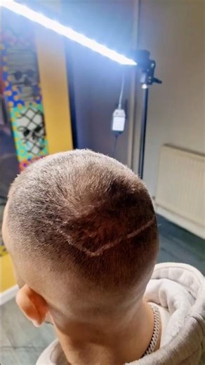 SMP hair tattoo realism restores confidence bold clean hairline ink transformation #Tattoo #SMP UK!!