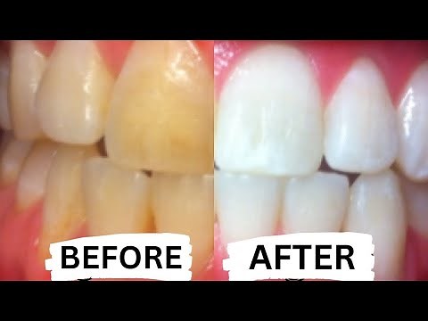 I Tried At-Home Teeth Whitening, So You Don't Have To