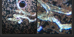 Correlation Of Severity Of Live Blood Contamination Seen On Darkfield Microscopy With Visible Clotting In C19 Unvaccinated Individual