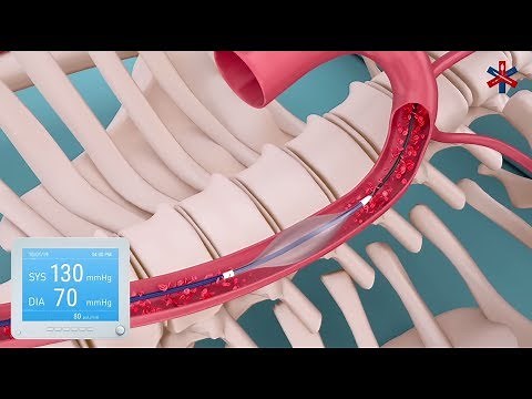 The EVTM REBOA Catheter Demonstration Video