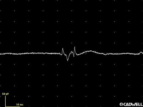 EMG teaching video 5: Abnormal spontaneous activity (PSW, Fibs and fasciculations)