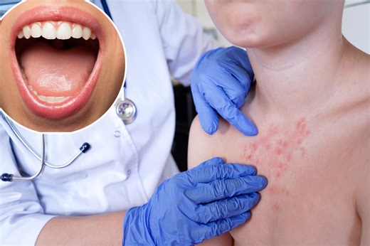 What are ‘Koplik spots’? The sneaky sign of measles you might get before a rash