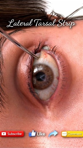 Lateral Tarsal Strip Surgery | Horizontal Eyelid Tightening Procedure | 3D Medical Animation 👁️