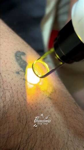 Laser Tattoo Removal | Safe & Advanced Treatment | Thanima Beauty Lounge