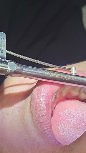 Torque settings on point. 📐 Securing the abutment into the implant fixture