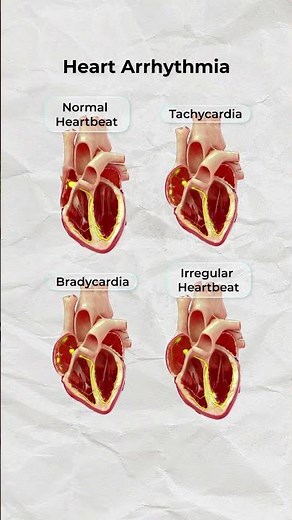 Types of Arrhythmias