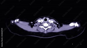 Computed tomography ( CT ) of whole human body From Head to Leg in Axial view with contrast agent . Check up for cancer concept.