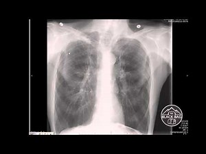 Xray Interpretation - COPD