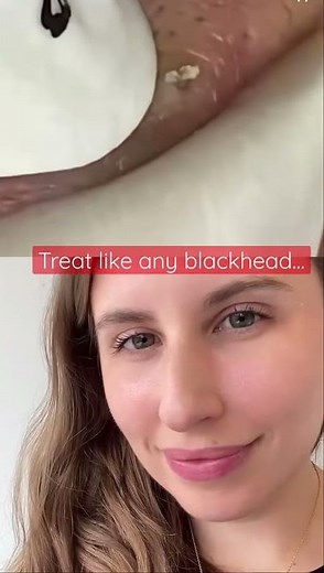 Blackhead Extraction On The Vermillion Border