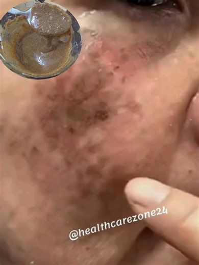 Clean Dark Spots and Pigmentation ✨Try This Recipes That Truly Work Quickly! | Health Care Zone