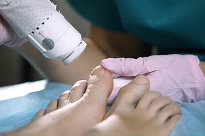 The Cost of Laser Nail Fungus Removal